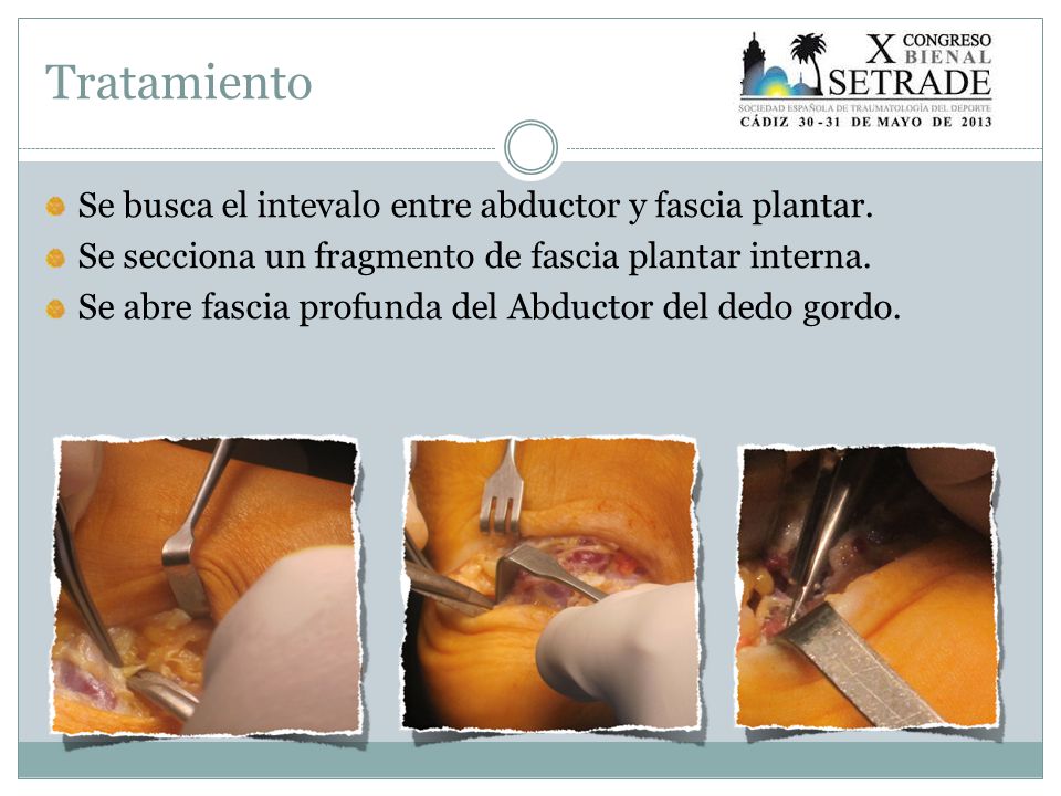 Tratamiento Se busca el intevalo entre abductor y fascia plantar.