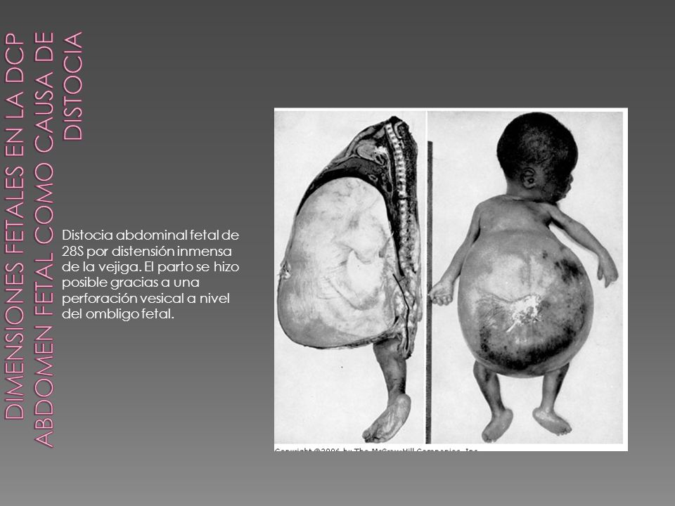 Dimensiones fetales en la DCP Abdomen fetal como causa de distocia