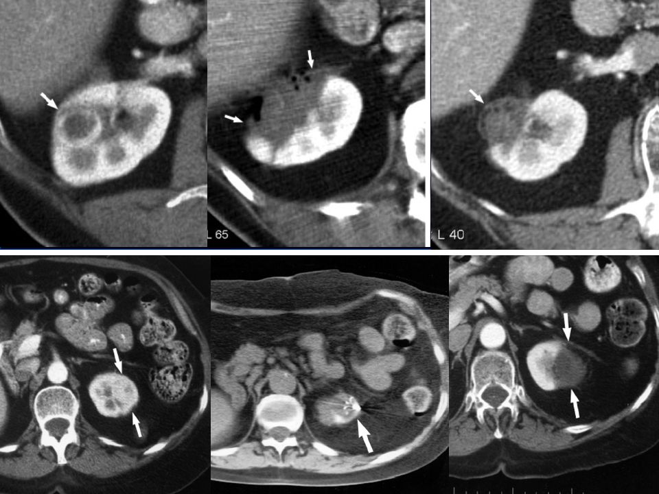 Estudio preablación que muestra un pequeño tumor cortical.