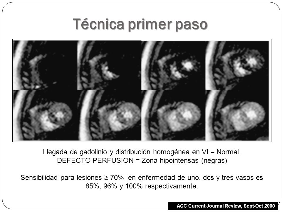 Técnica primer paso Llegada de gadolinio y distribución homogénea en VI = Normal. DEFECTO PERFUSION = Zona hipointensas (negras)