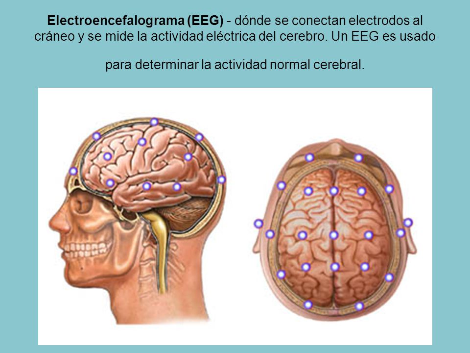 Electroencefalograma (EEG) - dónde se conectan electrodos al cráneo y se mide la actividad eléctrica del cerebro.