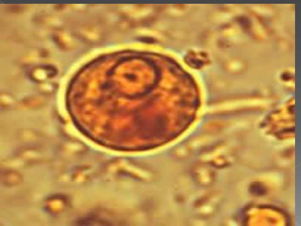 Definición Infección causada por la Entamoeba histolyca, que parasita al ser humano instalándose en el intestino grueso.