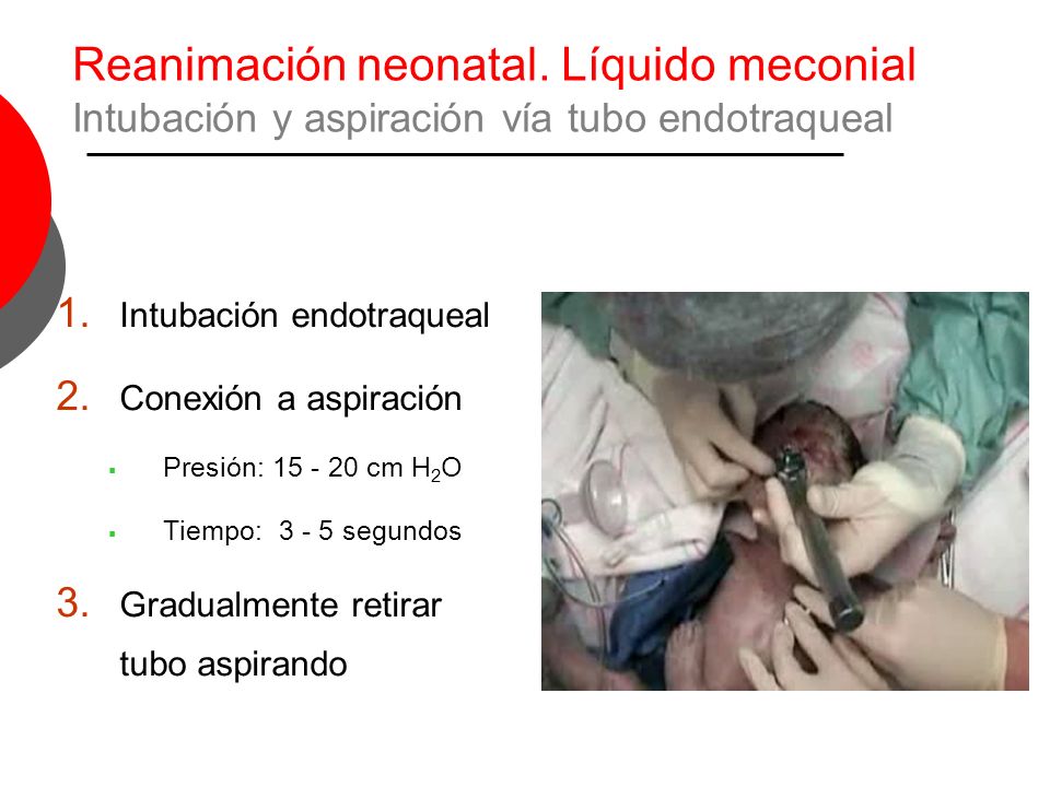 Reanimación neonatal. Líquido meconial Intubación y aspiración vía tubo endotraqueal