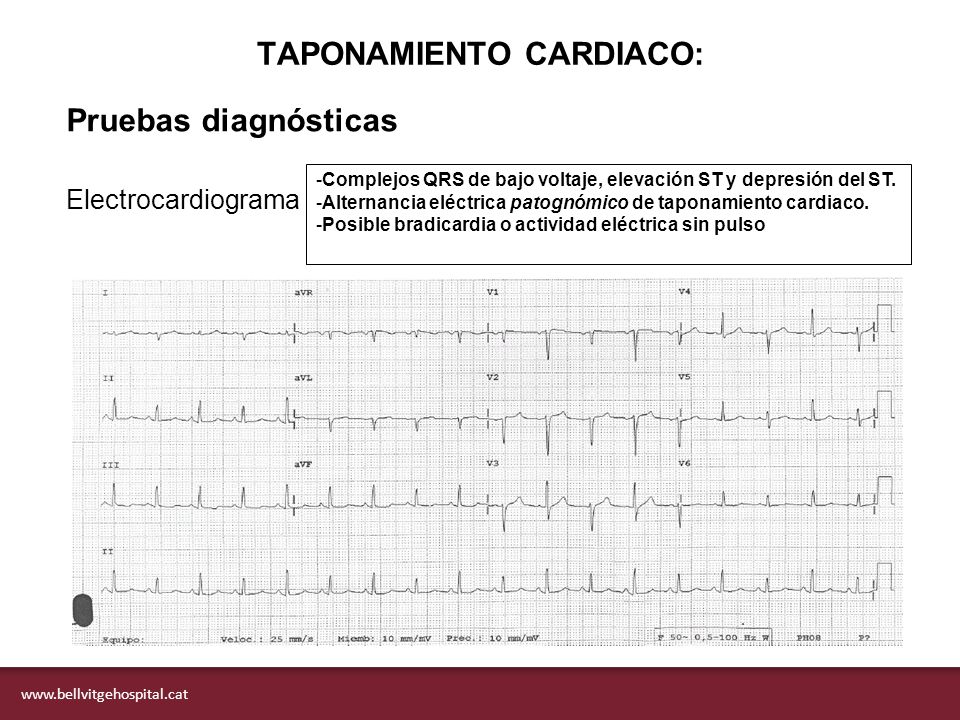 Taponamiento cardiaco Pericardiocentesis - ppt descargar