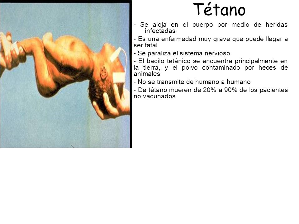 Tétano - Se aloja en el cuerpo por medio de heridas infectadas