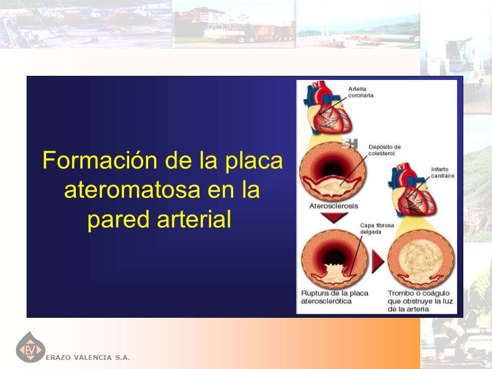 Formación de la placa ateromatosa en la pared arterial