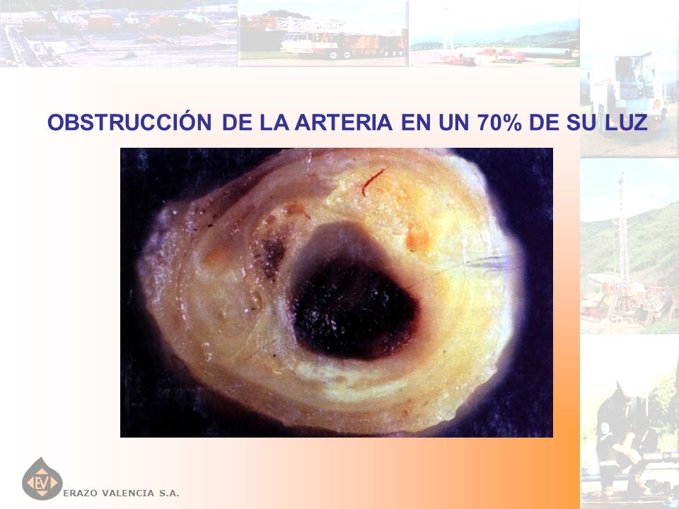 OBSTRUCCIÓN DE LA ARTERIA EN UN 70% DE SU LUZ