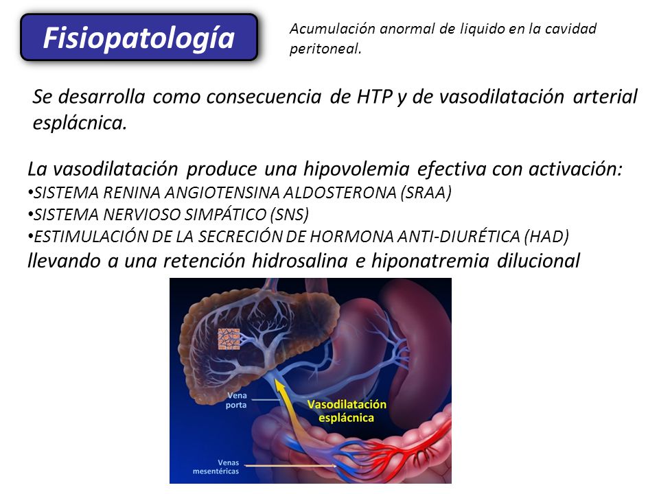 Fisiopatología Acumulación anormal de liquido en la cavidad peritoneal.