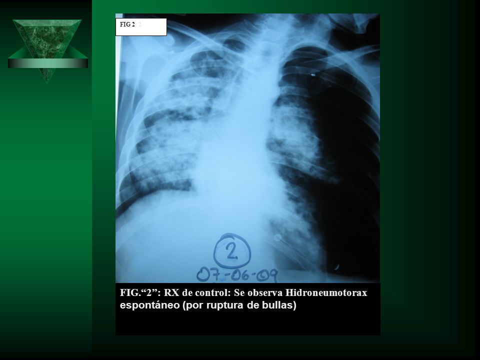 FIG 2: 2 FIG. 2 : RX de control: Se observa Hidroneumotorax espontáneo (por ruptura de bullas)