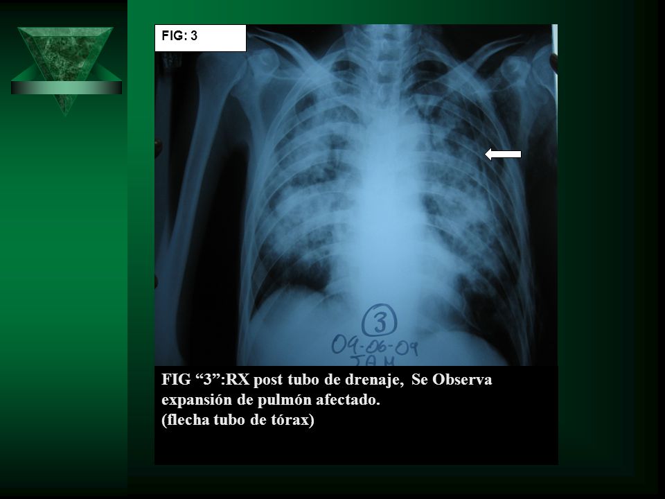 FIG: 3 FIG 3 :RX post tubo de drenaje, Se Observa expansión de pulmón afectado.