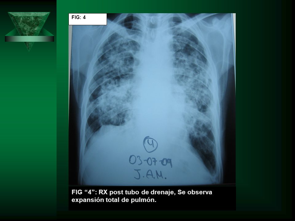 FIG: 4 FIG 4 : RX post tubo de drenaje, Se observa expansión total de pulmón.