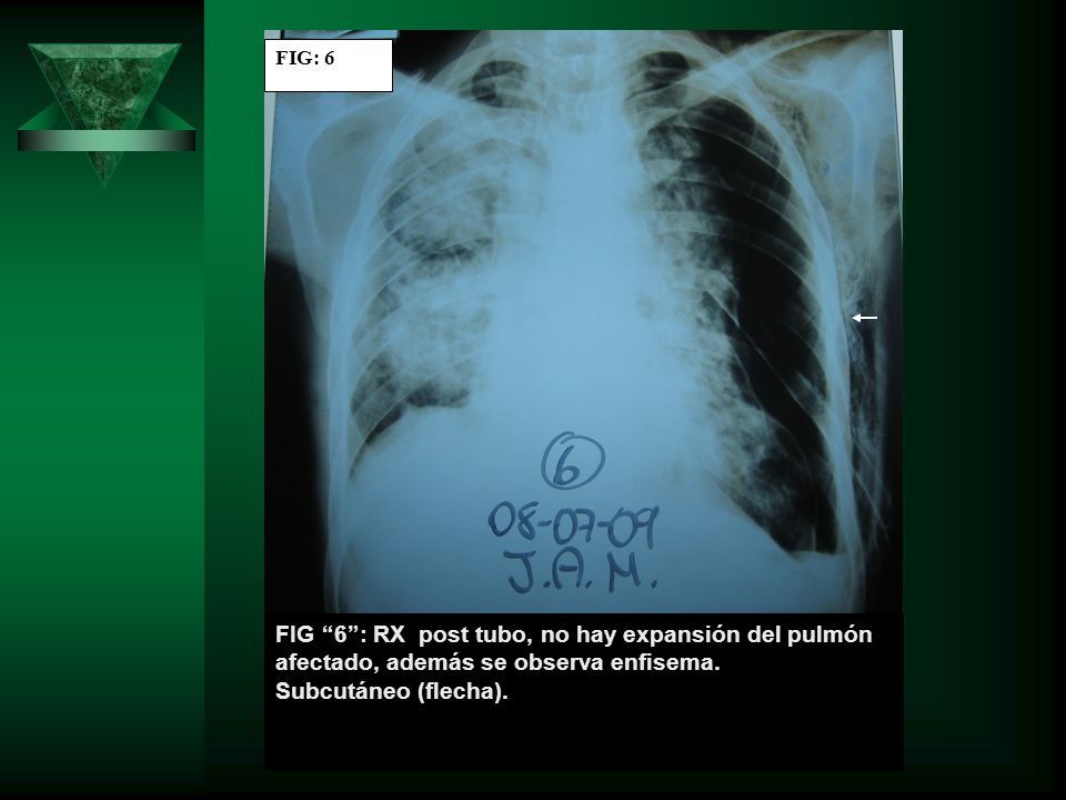 FIG: 6 FIG 6 : RX post tubo, no hay expansión del pulmón afectado, además se observa enfisema.