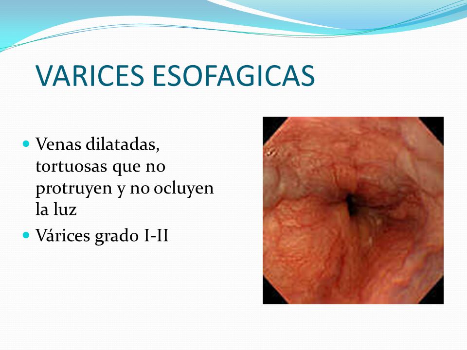 VARICES ESOFAGICAS Venas dilatadas, tortuosas que no protruyen y no ocluyen la luz.