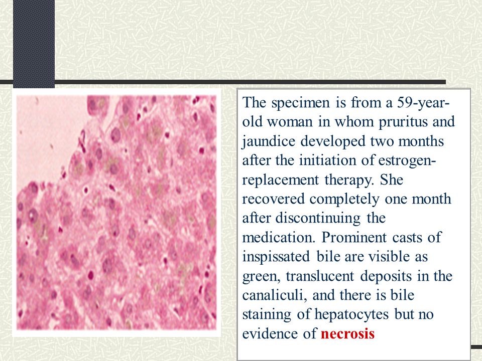 The specimen is from a 59-year-old woman in whom pruritus and jaundice developed two months after the initiation of estrogen-replacement therapy.
