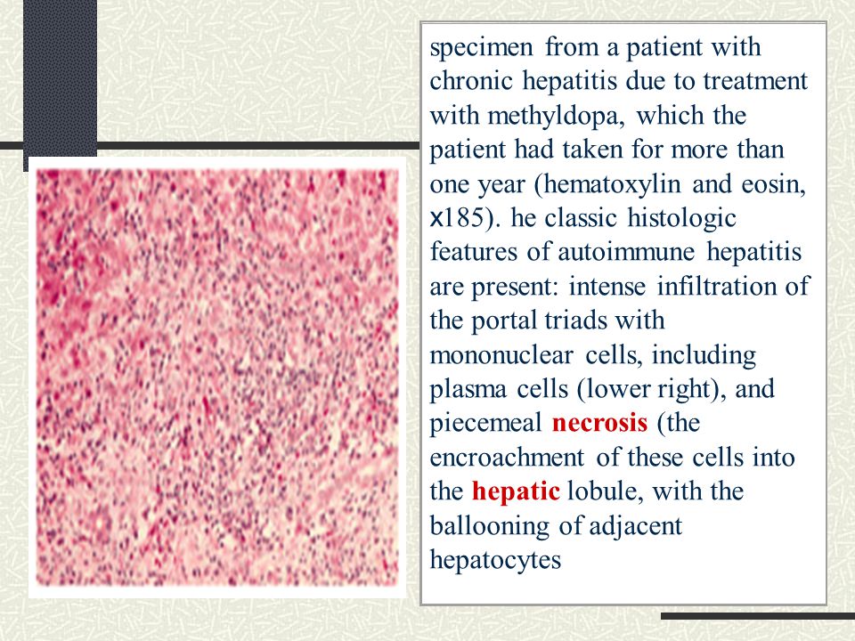 specimen from a patient with chronic hepatitis due to treatment with methyldopa, which the patient had taken for more than one year (hematoxylin and eosin, x185).