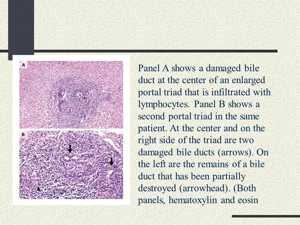 Panel A shows a damaged bile duct at the center of an enlarged portal triad that is infiltrated with lymphocytes.