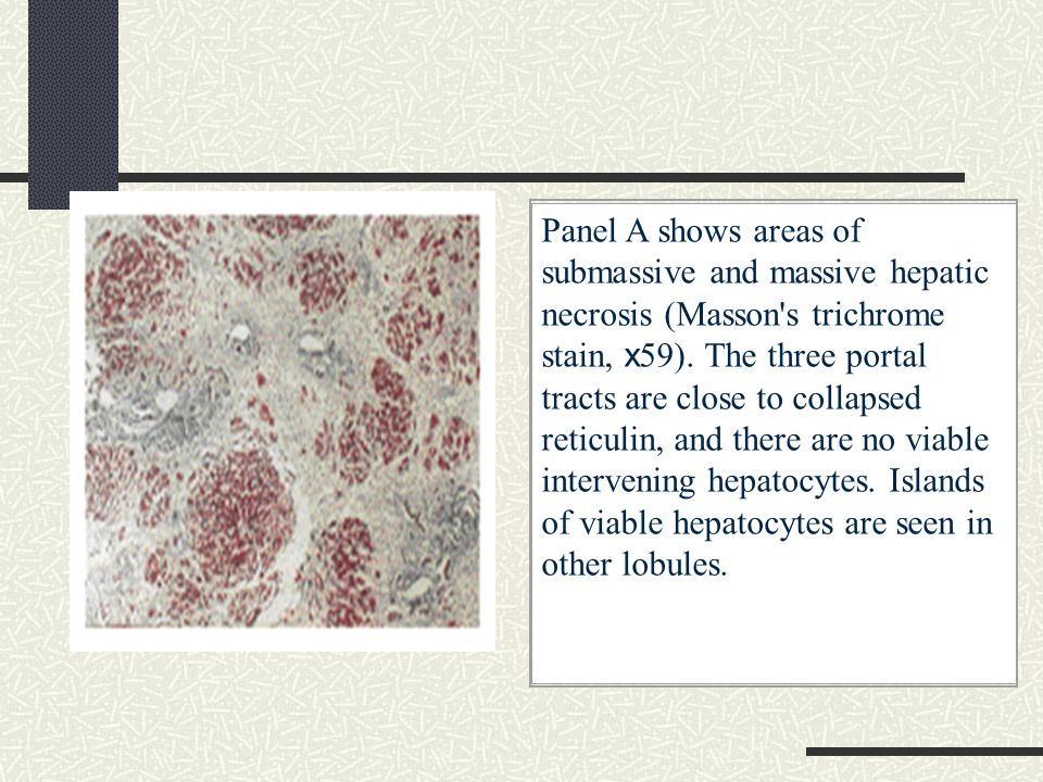Panel A shows areas of submassive and massive hepatic necrosis (Masson s trichrome stain, x59).
