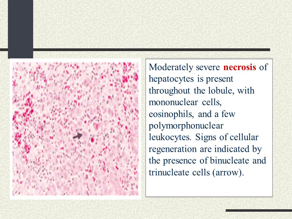Moderately severe necrosis of hepatocytes is present throughout the lobule, with mononuclear cells, eosinophils, and a few polymorphonuclear leukocytes.