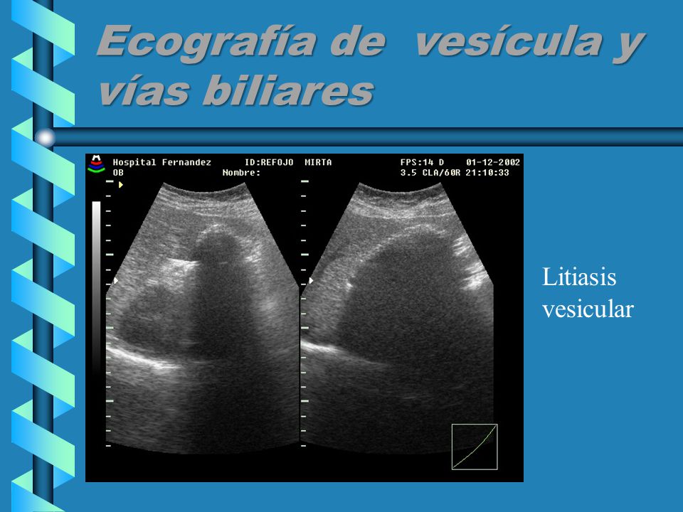 Ecografía de vesícula y vías biliares