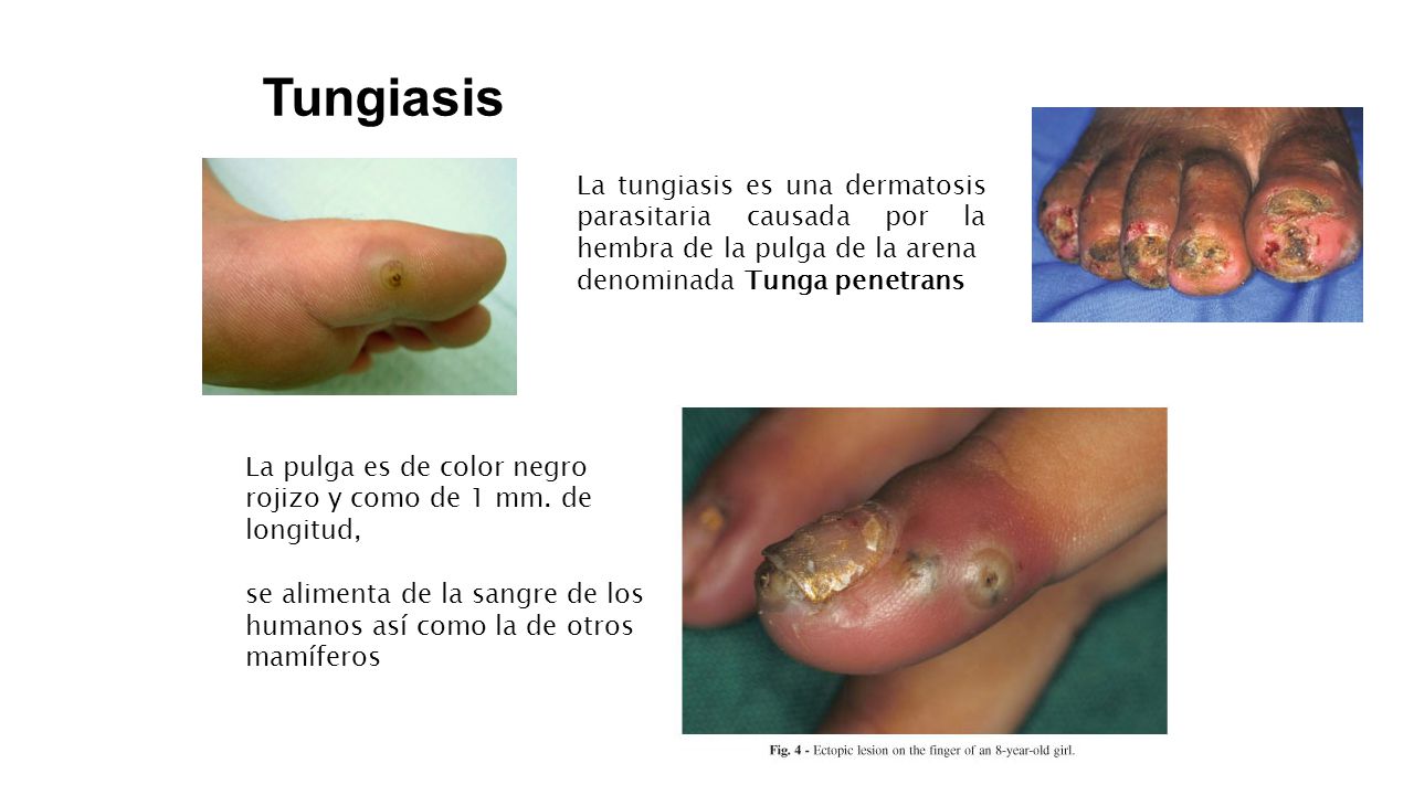 Tungiasis La tungiasis es una dermatosis parasitaria causada por la hembra de la pulga de la arena.