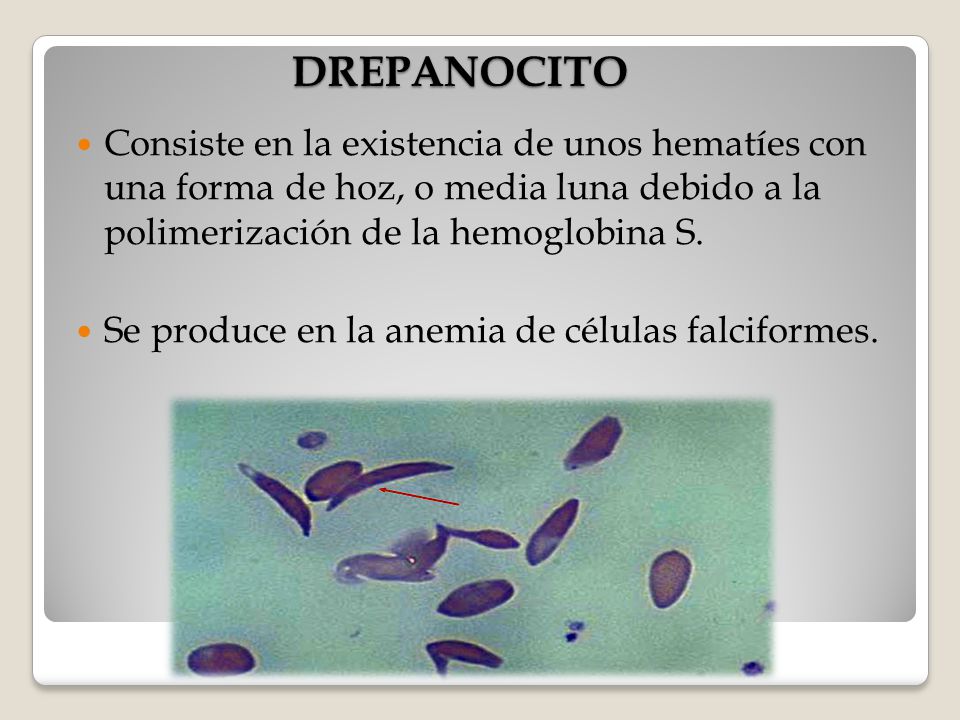 DREPANOCITO Consiste en la existencia de unos hematíes con una forma de hoz, o media luna debido a la polimerización de la hemoglobina S.