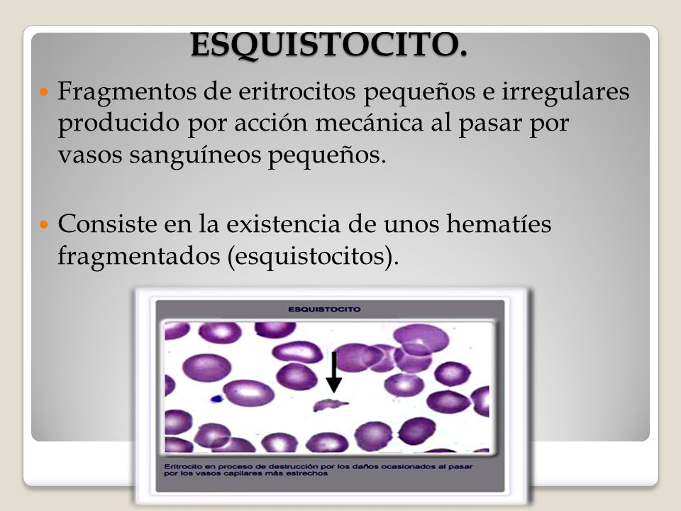 ESQUISTOCITO. Fragmentos de eritrocitos pequeños e irregulares producido por acción mecánica al pasar por vasos sanguíneos pequeños.