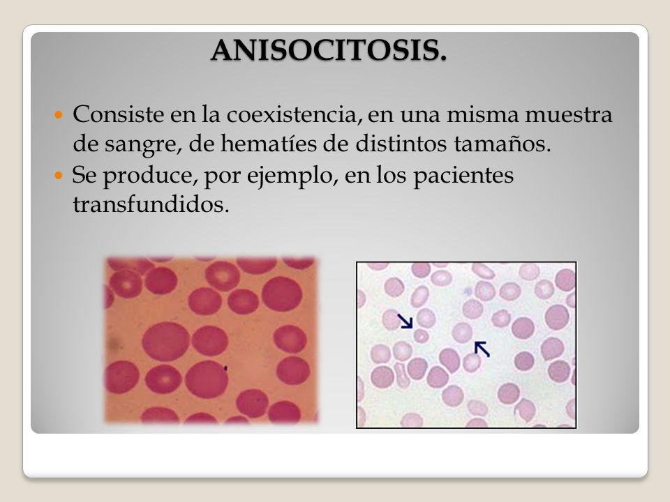 ANISOCITOSIS. Consiste en la coexistencia, en una misma muestra de sangre, de hematíes de distintos tamaños.