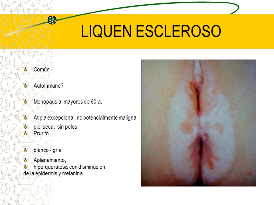 LIQUEN ESCLEROSO Común Autoinmune Menopausia, mayores de 60 a.