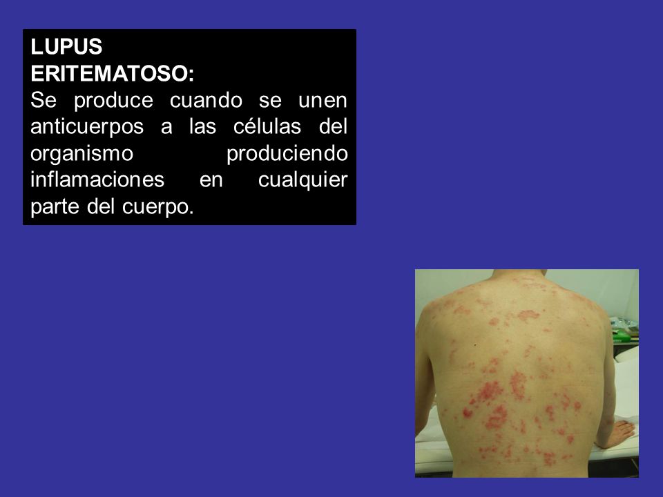 LUPUS ERITEMATOSO: Se produce cuando se unen anticuerpos a las células del organismo produciendo inflamaciones en cualquier parte del cuerpo.