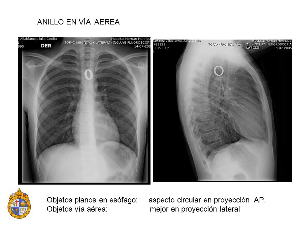 Objetos planos en esófago: aspecto circular en proyección AP.
