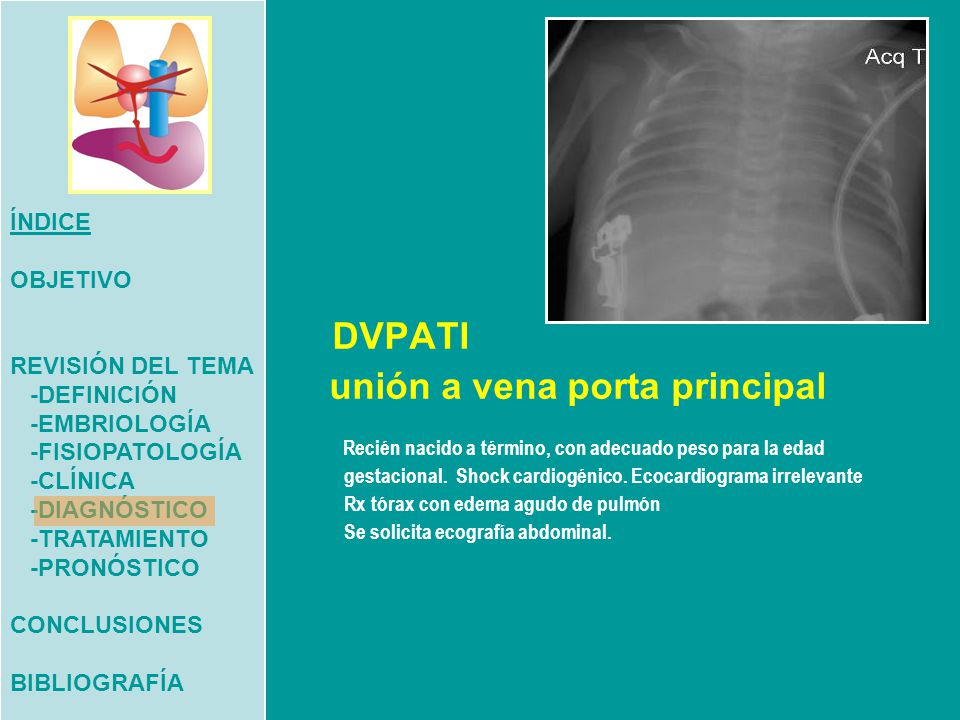 ÍNDICE OBJETIVO. REVISIÓN DEL TEMA. -DEFINICIÓN. -EMBRIOLOGÍA. -FISIOPATOLOGÍA. -CLÍNICA. -DIAGNÓSTICO.