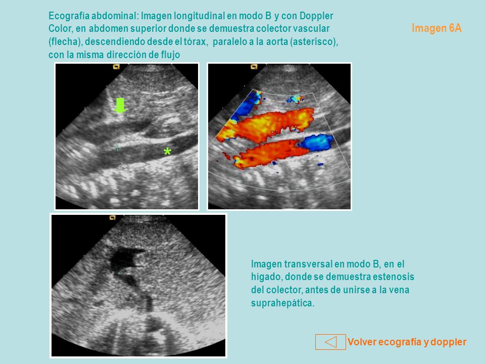 Ecografía abdominal: Imagen longitudinal en modo B y con Doppler Color, en abdomen superior donde se demuestra colector vascular (flecha), descendiendo desde el tórax, paralelo a la aorta (asterisco), con la misma dirección de flujo