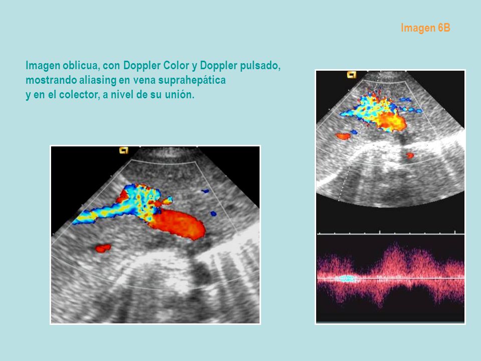 Imagen 6B Imagen oblicua, con Doppler Color y Doppler pulsado, mostrando aliasing en vena suprahepática.