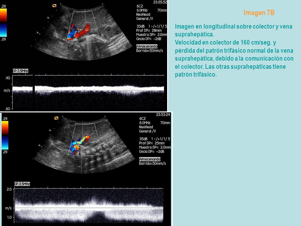 Imagen 7B Imagen en longitudinal sobre colector y vena suprahepática.