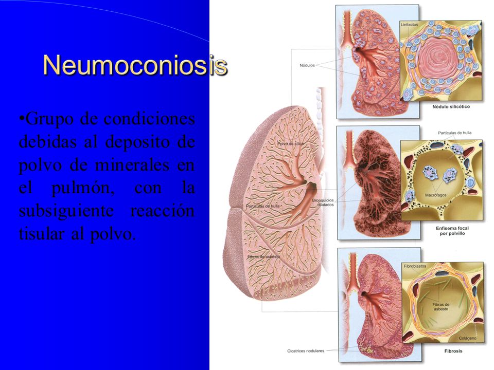 Neumoconiosis Grupo de condiciones debidas al deposito de polvo de minerales en el pulmón, con la subsiguiente reacción tisular al polvo.