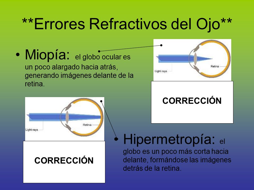 **Errores Refractivos del Ojo**