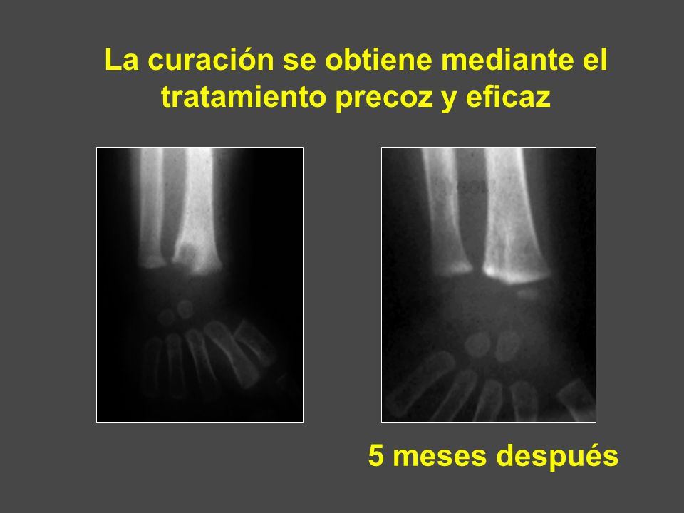 La curación se obtiene mediante el tratamiento precoz y eficaz