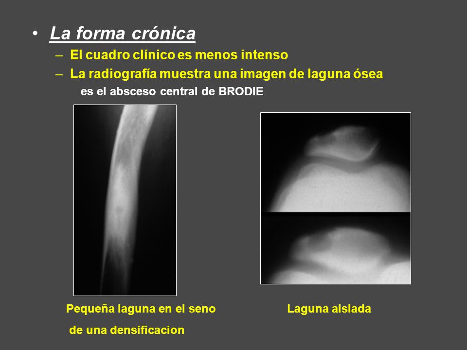 La forma crónica El cuadro clínico es menos intenso