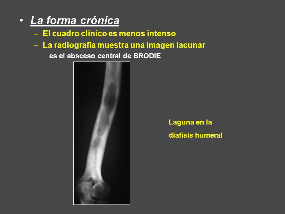 La forma crónica El cuadro clínico es menos intenso