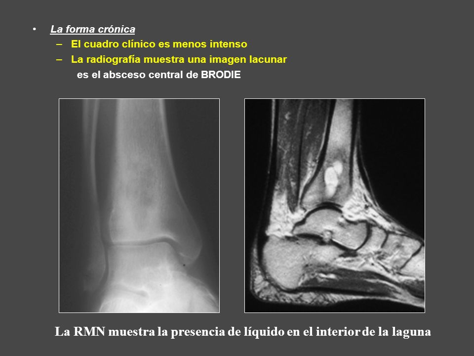 La RMN muestra la presencia de líquido en el interior de la laguna
