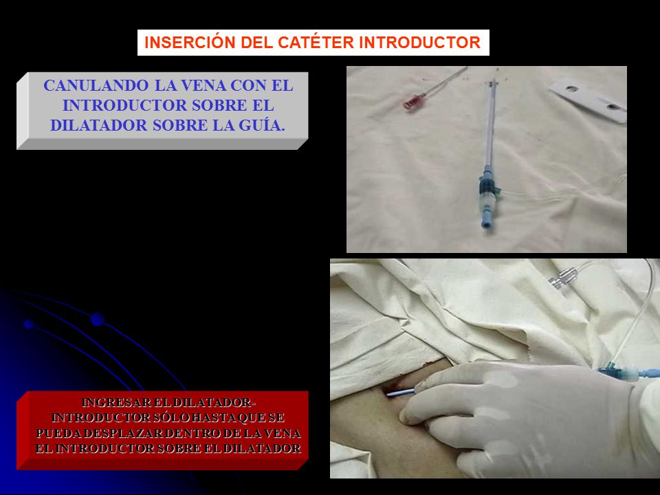 CANULANDO LA VENA CON EL INTRODUCTOR SOBRE EL DILATADOR SOBRE LA GUÍA.