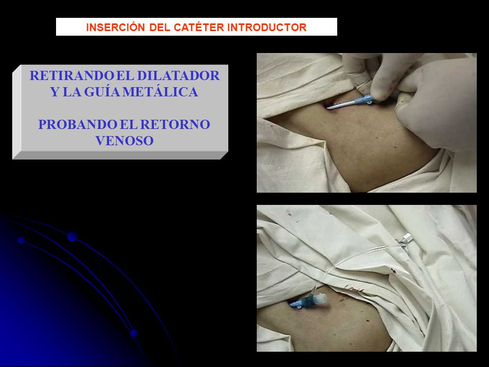 RETIRANDO EL DILATADOR Y LA GUÍA METÁLICA PROBANDO EL RETORNO VENOSO