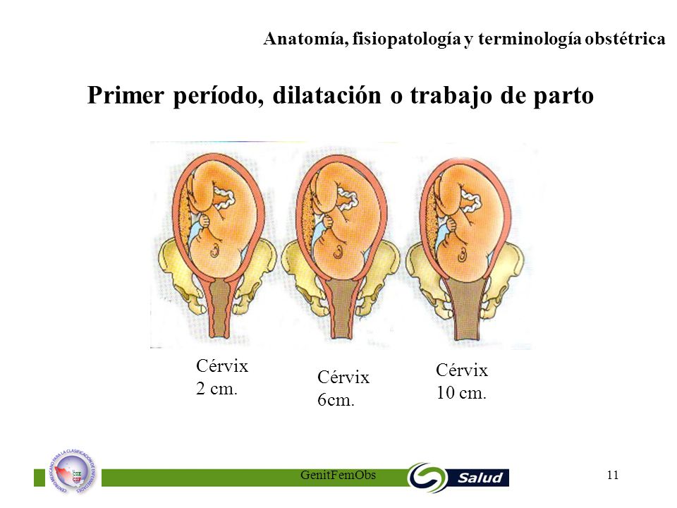 Primer período, dilatación o trabajo de parto