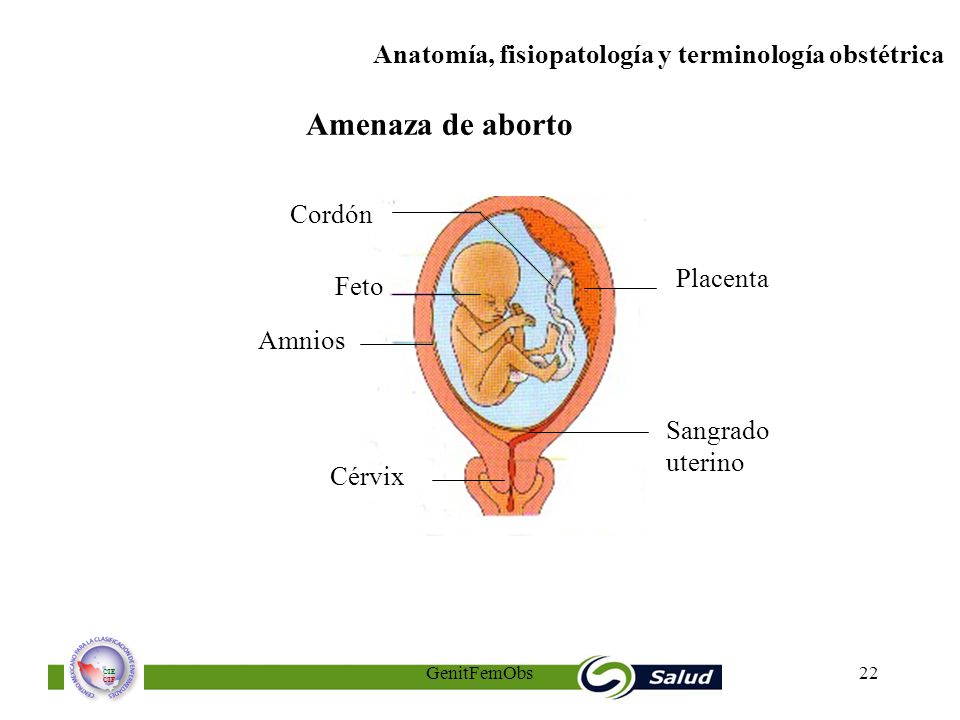 Amenaza de aborto Cordón Placenta Feto Amnios Sangrado uterino Cérvix