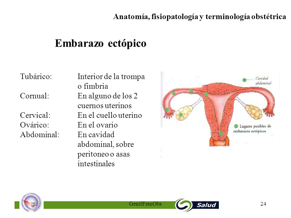 Embarazo ectópico Tubárico: Interior de la trompa o fimbria