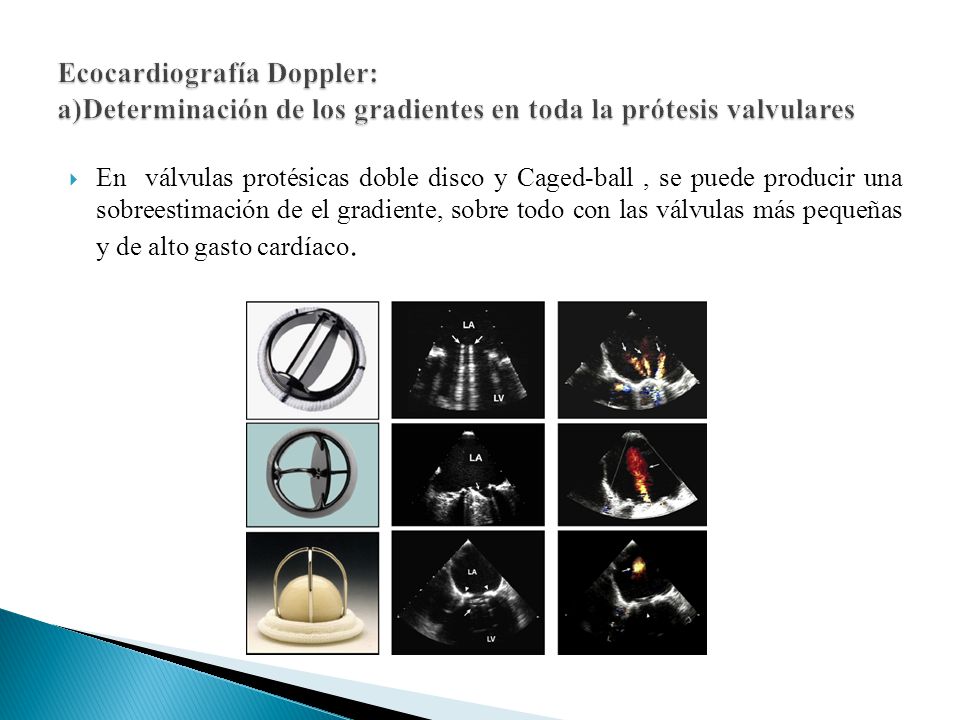 Ecocardiografía Doppler: a)Determinación de los gradientes en toda la prótesis valvulares