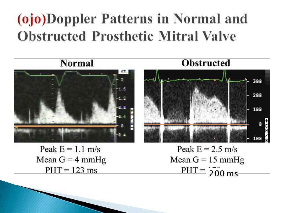 (ojo)Doppler Patterns in Normal and Obstructed Prosthetic Mitral Valve