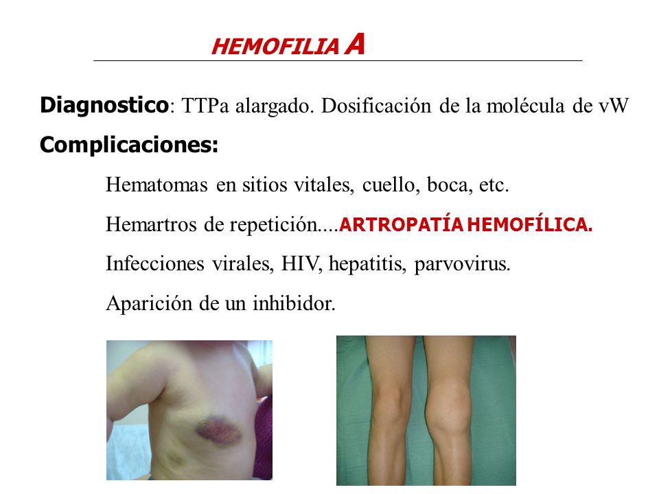 HEMOFILIA A Diagnostico: TTPa alargado. Dosificación de la molécula de vW. Complicaciones: Hematomas en sitios vitales, cuello, boca, etc.
