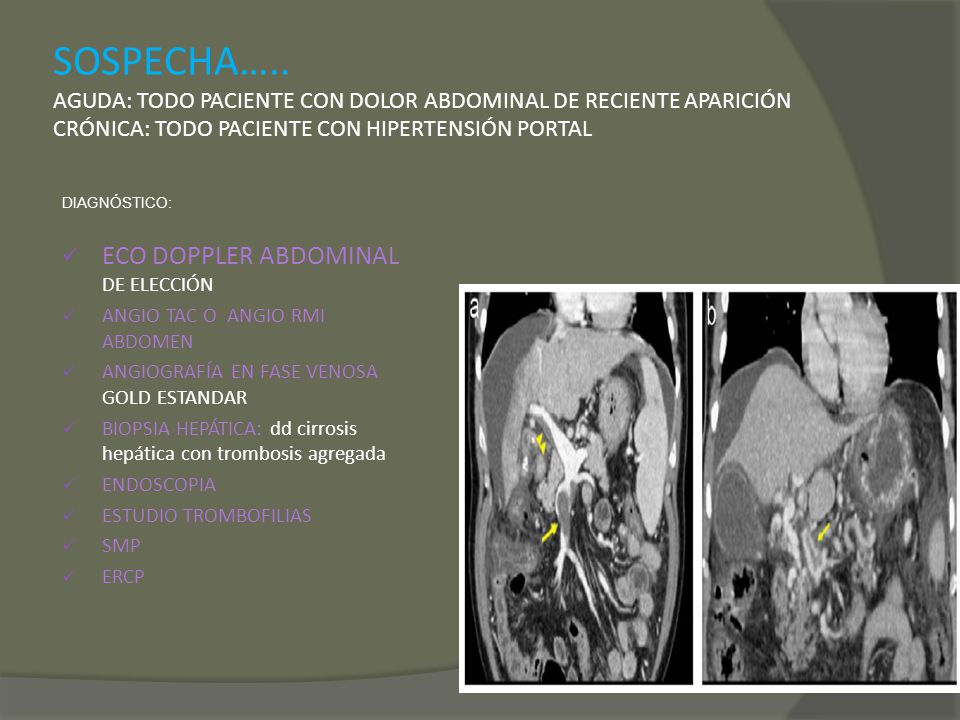 SOSPECHA….. AGUDA: TODO PACIENTE CON DOLOR ABDOMINAL DE RECIENTE APARICIÓN CRÓNICA: TODO PACIENTE CON HIPERTENSIÓN PORTAL