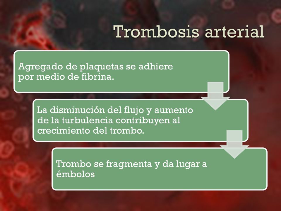 Trombosis arterial Agregado de plaquetas se adhiere por medio de fibrina.
